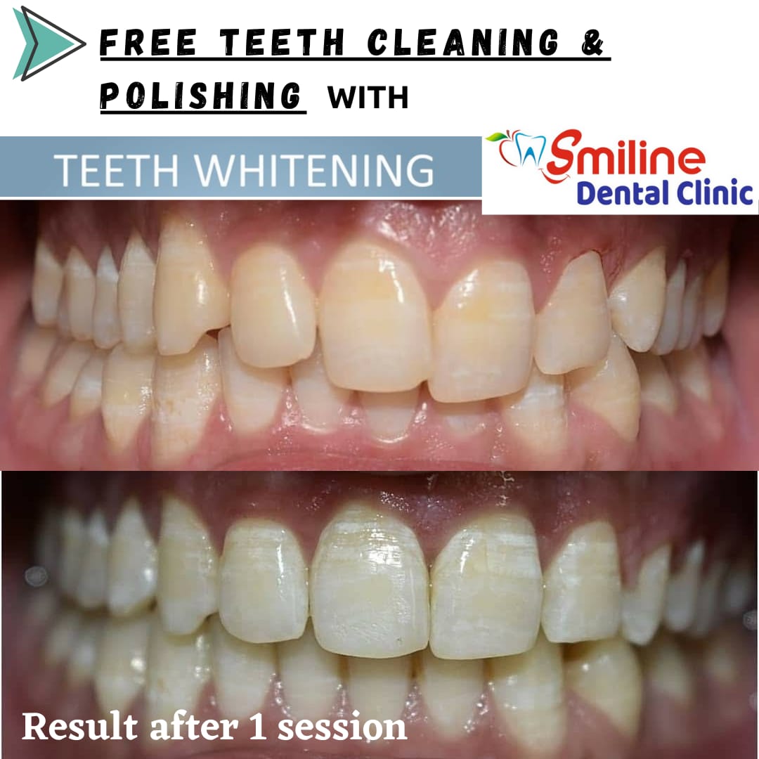 Smiline Dental Clinic teeth whitening result Saket South Delhi